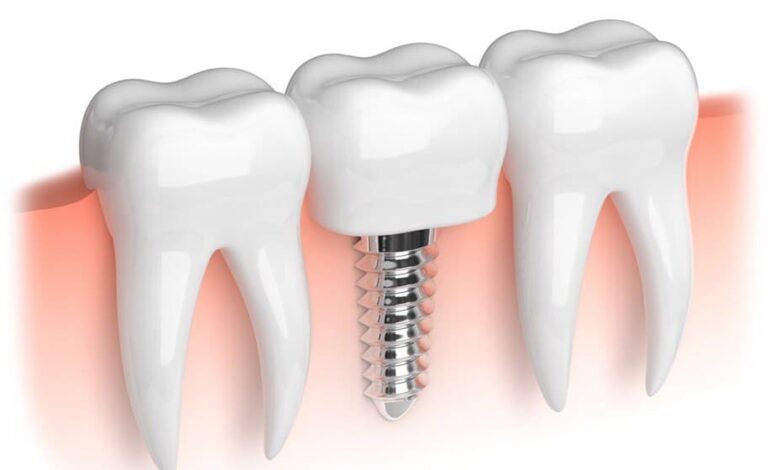 Devlet Hastanesinde Implant Yaptiranlar 1