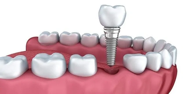 Devlet Hastanesinde Implant Yaptiranlar